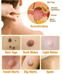 HOOMWELL™ Gentle Skin Tag & Wart Removal Spray with Tea Tree Oil