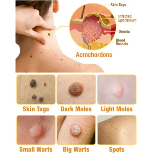 HOOMWELL™ Gentle Skin Tag & Wart Removal Spray with Tea Tree Oil