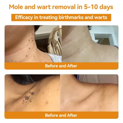 HOOMWELL™ Gentle Skin Tag & Wart Removal Spray with Tea Tree Oil