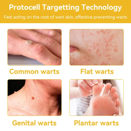 HOOMWELL™ Gentle Skin Tag & Wart Removal Spray with Tea Tree Oil