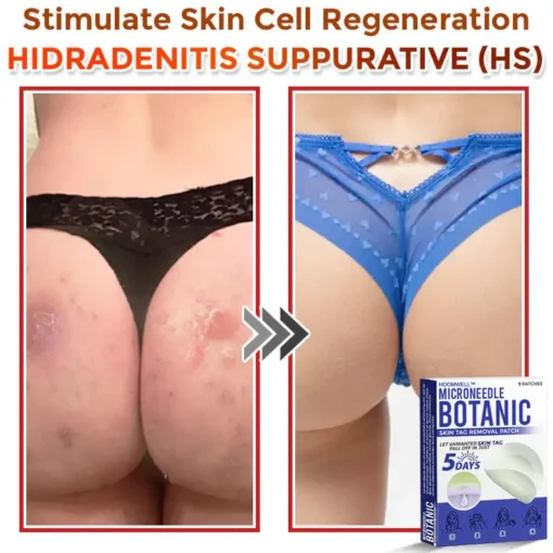 HOOMWELL™ MicroNeedle Botanic Skin Tag Removal Patch