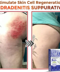HOOMWELL™ MicroNeedle Botanic Skin Tag Removal Patch