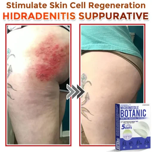 HOOMWELL™ MicroNeedle Botanic Skin Tag Removal Patch