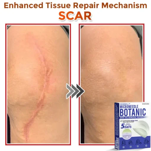 HOOMWELL™ MicroNeedle Botanic Skin Tag Removal Patch
