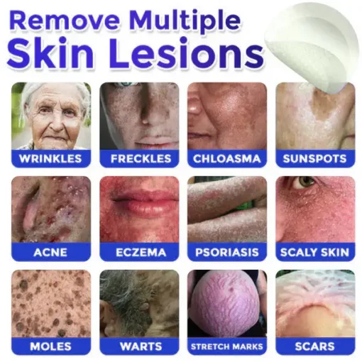 HOOMWELL™ MicroNeedle Botanic Skin Tag Removal Patch