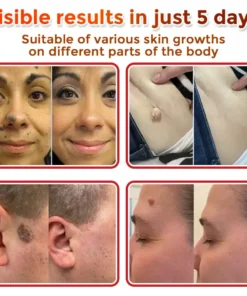 HOOMWELL™ MicroNeedle Botanic Skin Tag Removal Patch
