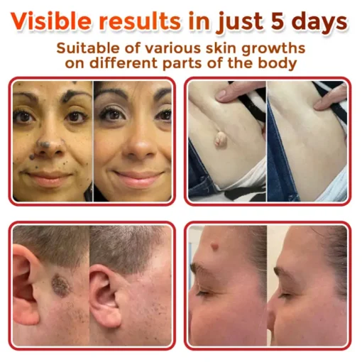 HOOMWELL™ MicroNeedle Botanic Skin Tag Removal Patch