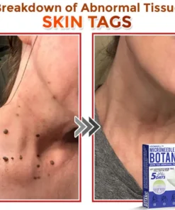 HOOMWELL™ MicroNeedle Botanic Skin Tag Removal Patch
