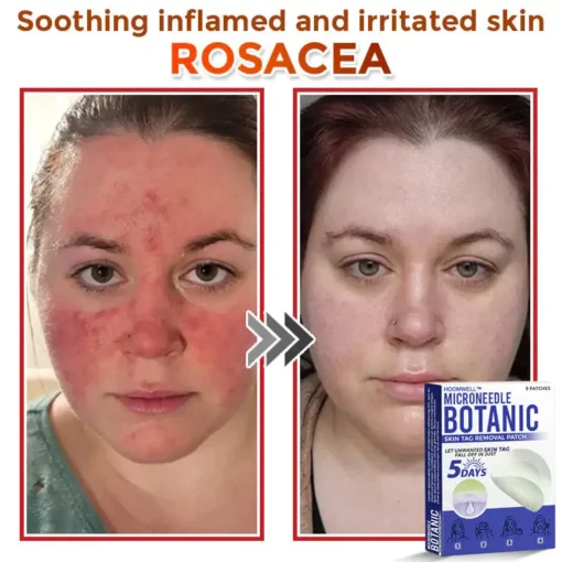 HOOMWELL™ MicroNeedle Botanic Skin Tag Removal Patch