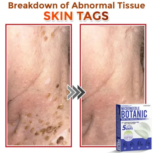 HOOMWELL™ MicroNeedle Botanic Skin Tag Removal Patch
