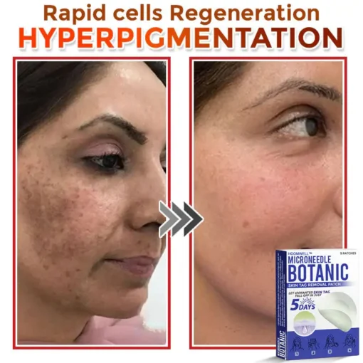 HOOMWELL™ MicroNeedle Botanic Skin Tag Removal Patch