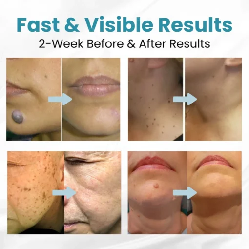 HOOMWELL™ Non-Invasive Mole and Wart Removal Laser Pen