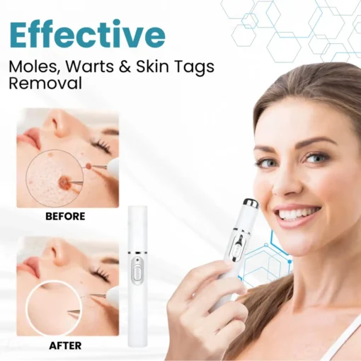 HOOMWELL™ Non-Invasive Mole and Wart Removal Laser Pen