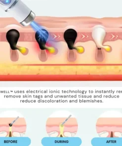 HOOMWELL™ Non-Invasive Mole and Wart Removal Laser Pen