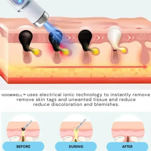 HOOMWELL™ Non-Invasive Mole and Wart Removal Laser Pen