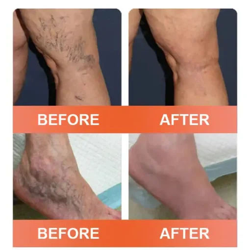 HOOMWELL™ VeinEase Mikronadel-Therapie- Aufnaher
