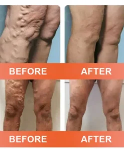HOOMWELL™ VeinEase Mikronadel-Therapie- Aufnaher